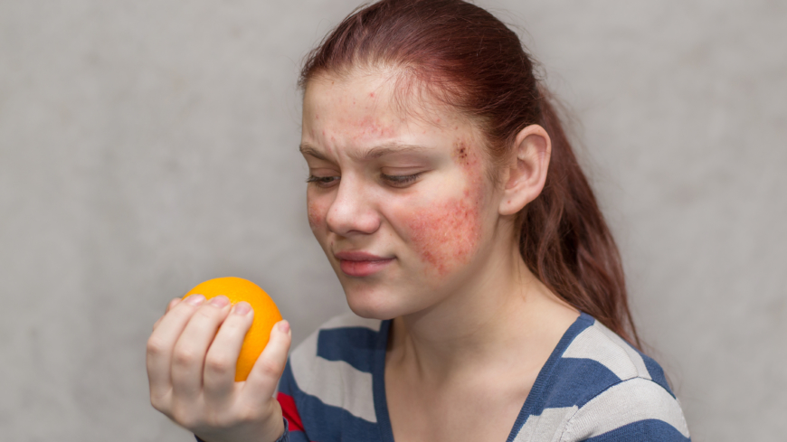 När en pollenallergiker får korsallergi handlar det ofta om olika typer av frukter eller bär. Foto: Shutterstock